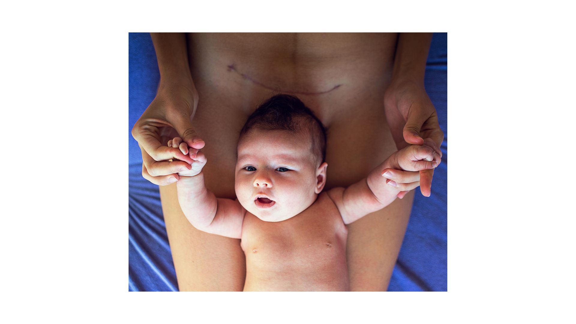 The Surgical Birth Support Blackhole